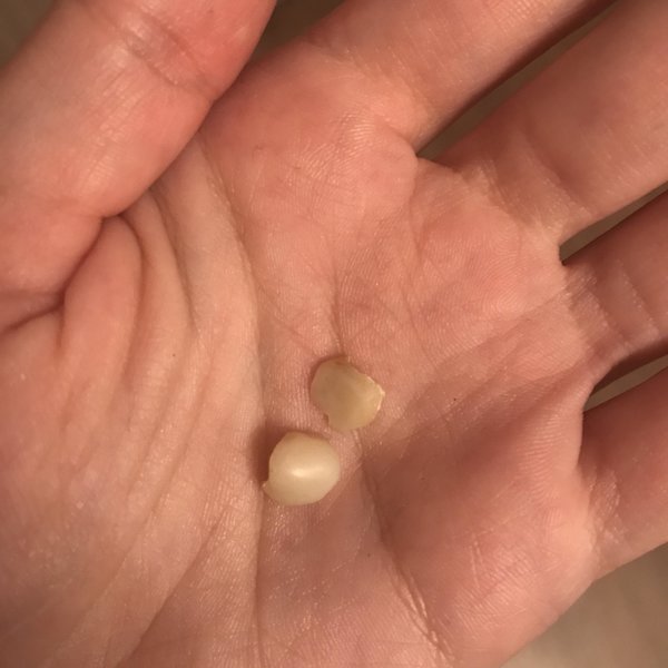 Here’s What You Need to Know About Tonsil Stones