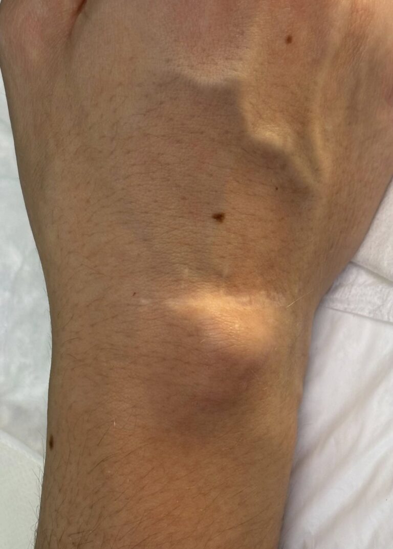 Do you have a lump on your wrist? Pay close attention to these symptoms, don’t ignore them.