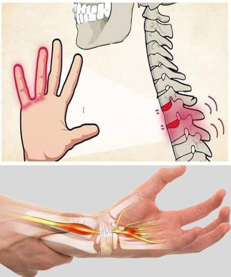 Hand Numbness: Is It Normal or a Symptom of a Problem?