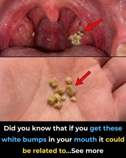 Did you know that if you get these white bumps in your mouth, it could be related to… See more