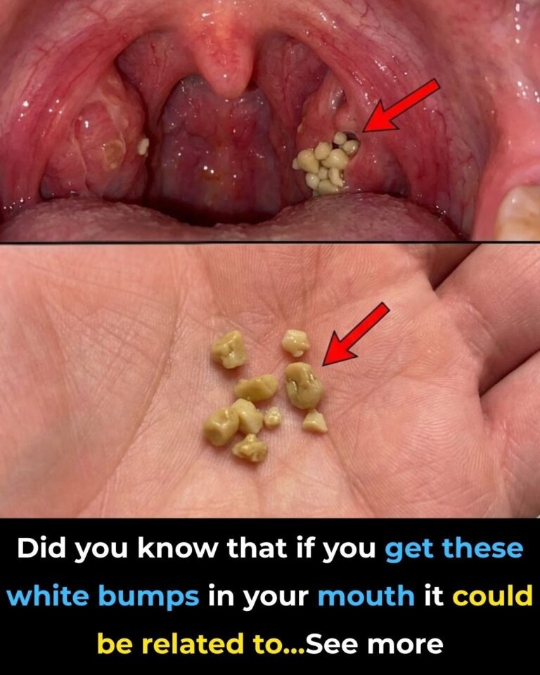 Did you know that if you get these white bumps in your mouth, it could be related to… See more