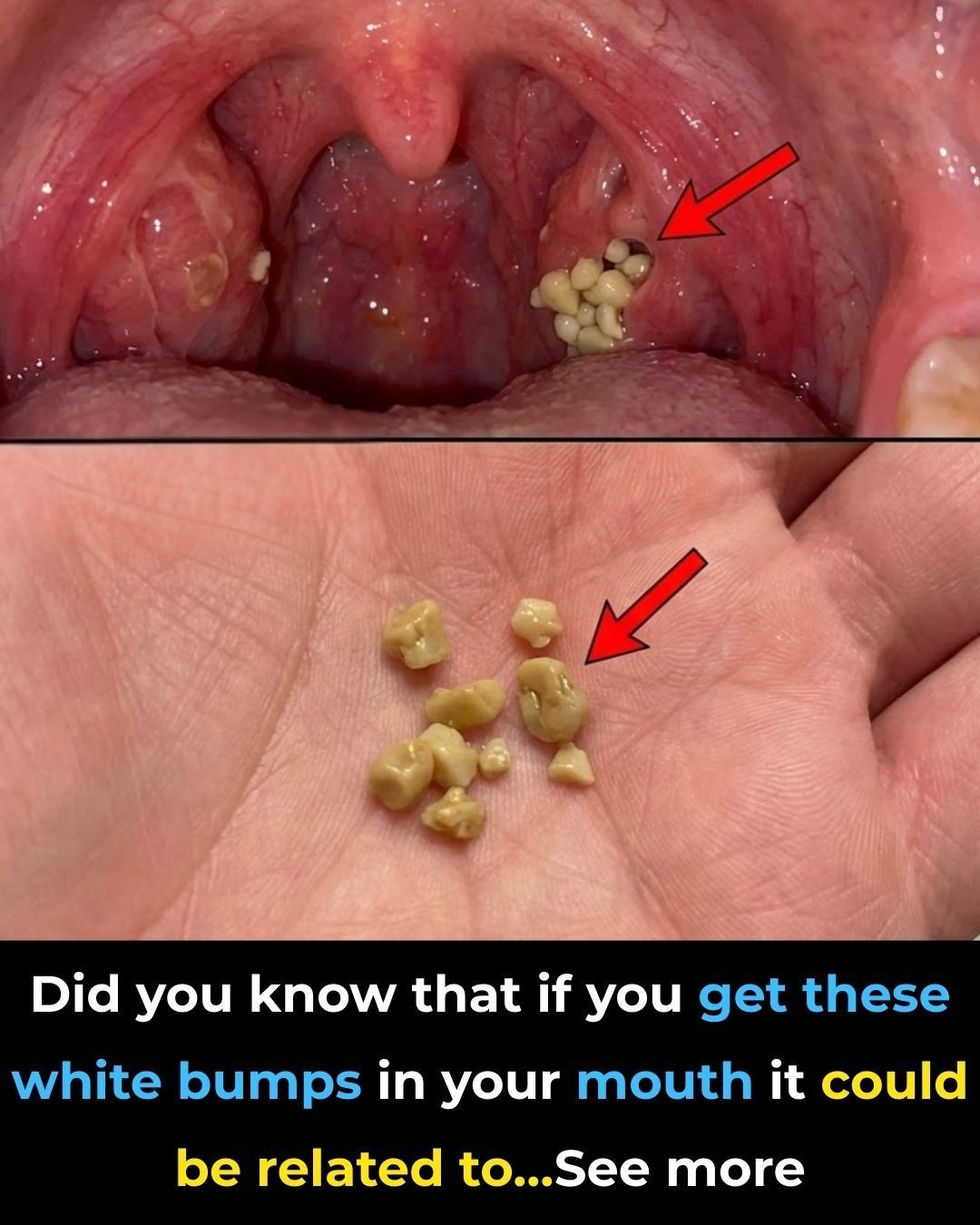 Did you know that if you get these white bumps in your mouth, it could be related to… See more