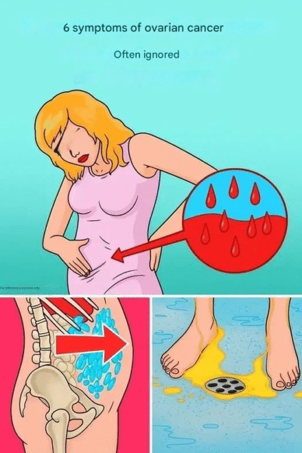 6 Often Missed Symptoms of Ovarian Cancer