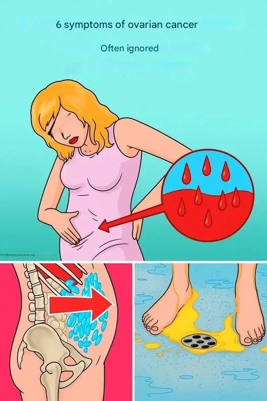 6 Often Missed Symptoms of Ovarian Cancer