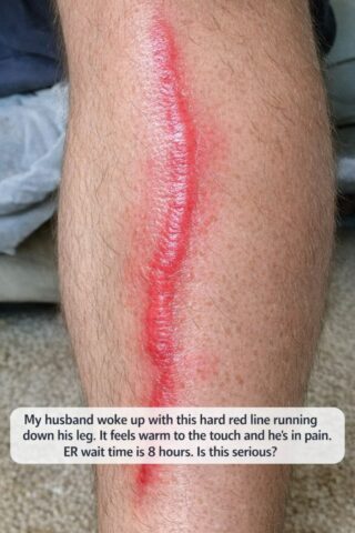 My Husband Woke Up With a Hard Red Line Running Down His Leg It’s Warm and Painful. Is This Something Serious?