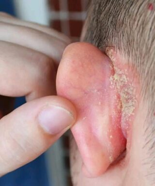 Caring for Your Child’s Ear: A Parent-Friendly Guide to Understanding Skin Changes