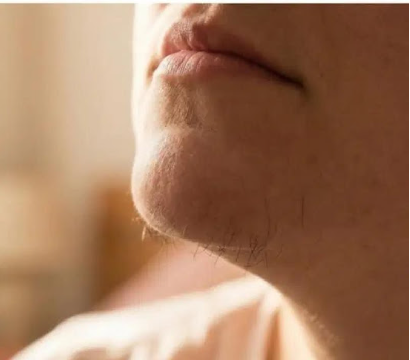 What Chin Hair in Women Really Says About Horm:ones