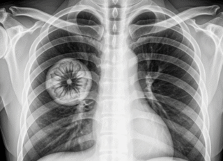 This rare disease is now linked to vaping…See more