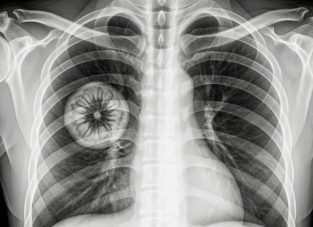 This rare disease is now linked to vaping…See more
