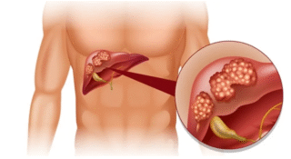 5 liver signs every woman should know