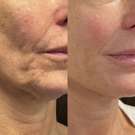 Clove and lemon collagen drink: Radiant, wrinkle-free skin