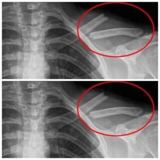 The Bone-Destroying Toxin You Drink Every Day: Exposing Soda’s Dangerous Side Effects
