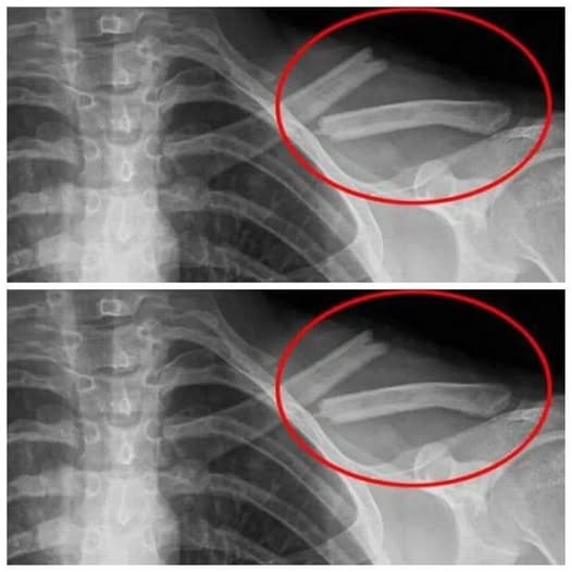 The Bone-Destroying Toxin You Drink Every Day: Exposing Soda’s Dangerous Side Effects