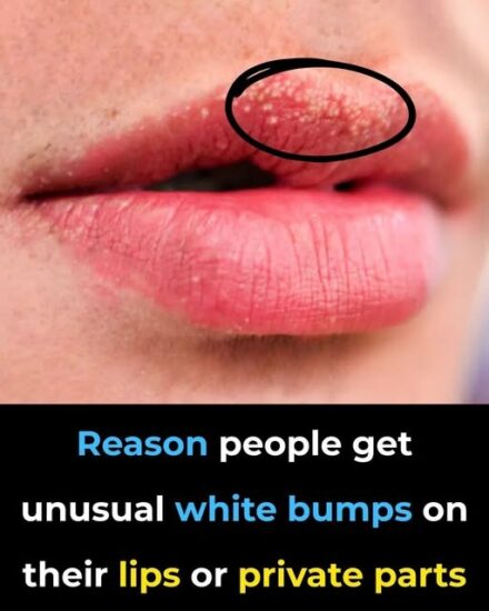 Reason behind strange white bumps found on your private parts