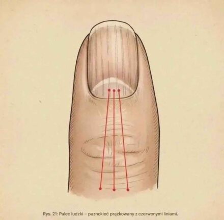 Silent warnings in fingernails