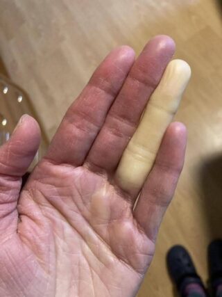 The Winter Alarm: Why Your Fingers Turn White or Blue — And the Widespread Condition Many Never Realize They Have