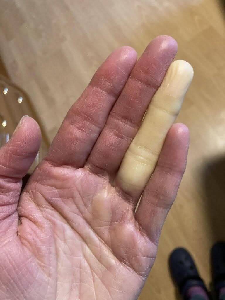 The Winter Alarm: Why Your Fingers Turn White or Blue — And the Widespread Condition Many Never Realize They Have